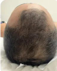 Alopecia androgenética