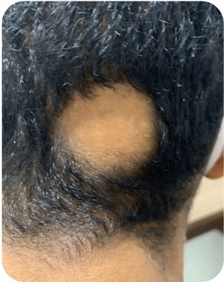 Alopecia areata