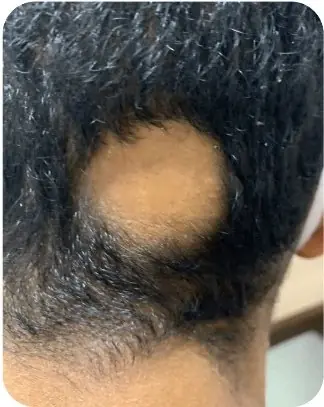 Alopecia areata