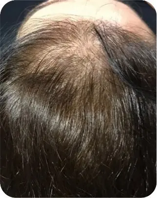 Alopecia padrão feminino