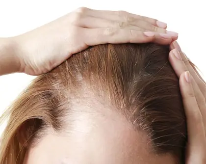 Alopecia de tração